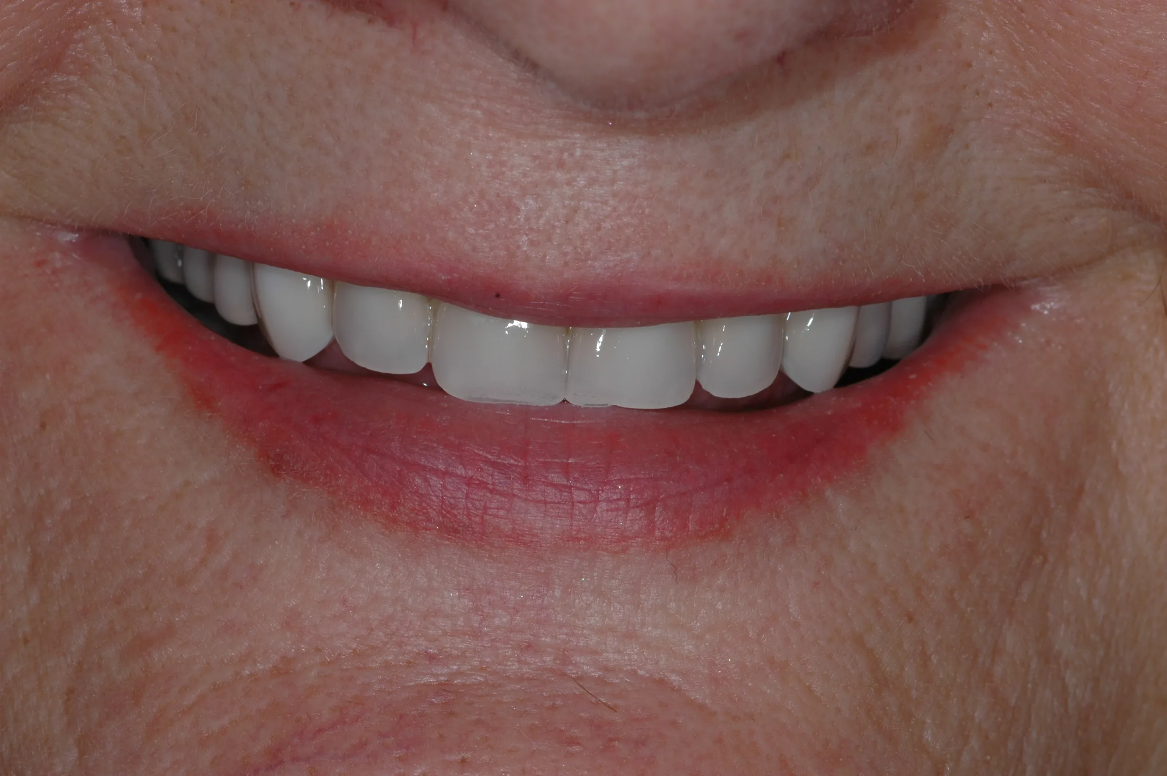 Before — Dentures