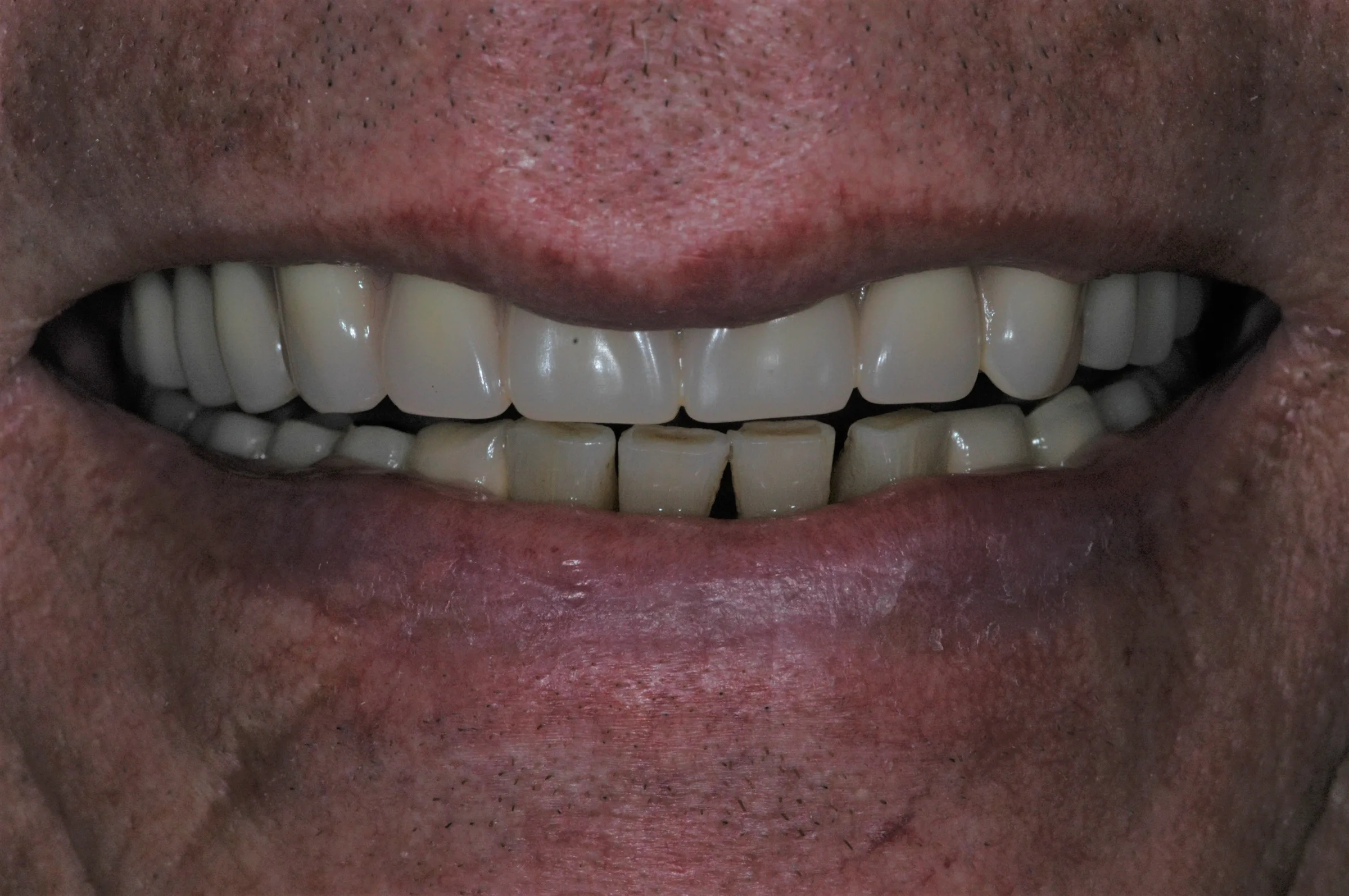 After — Dentures