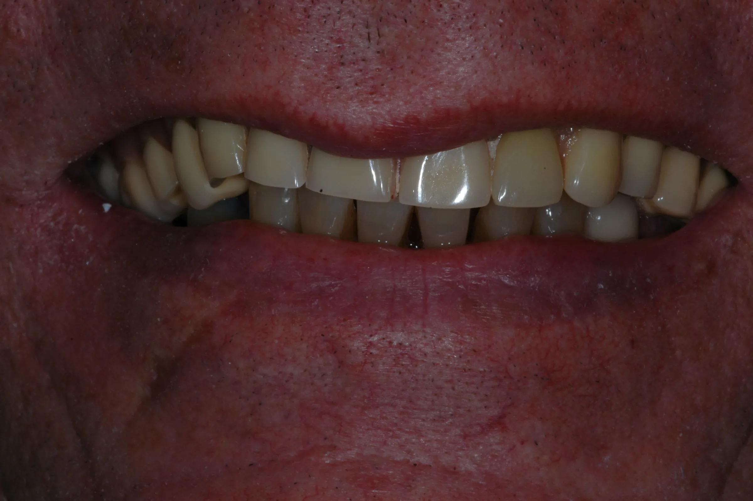 Before — Dentures