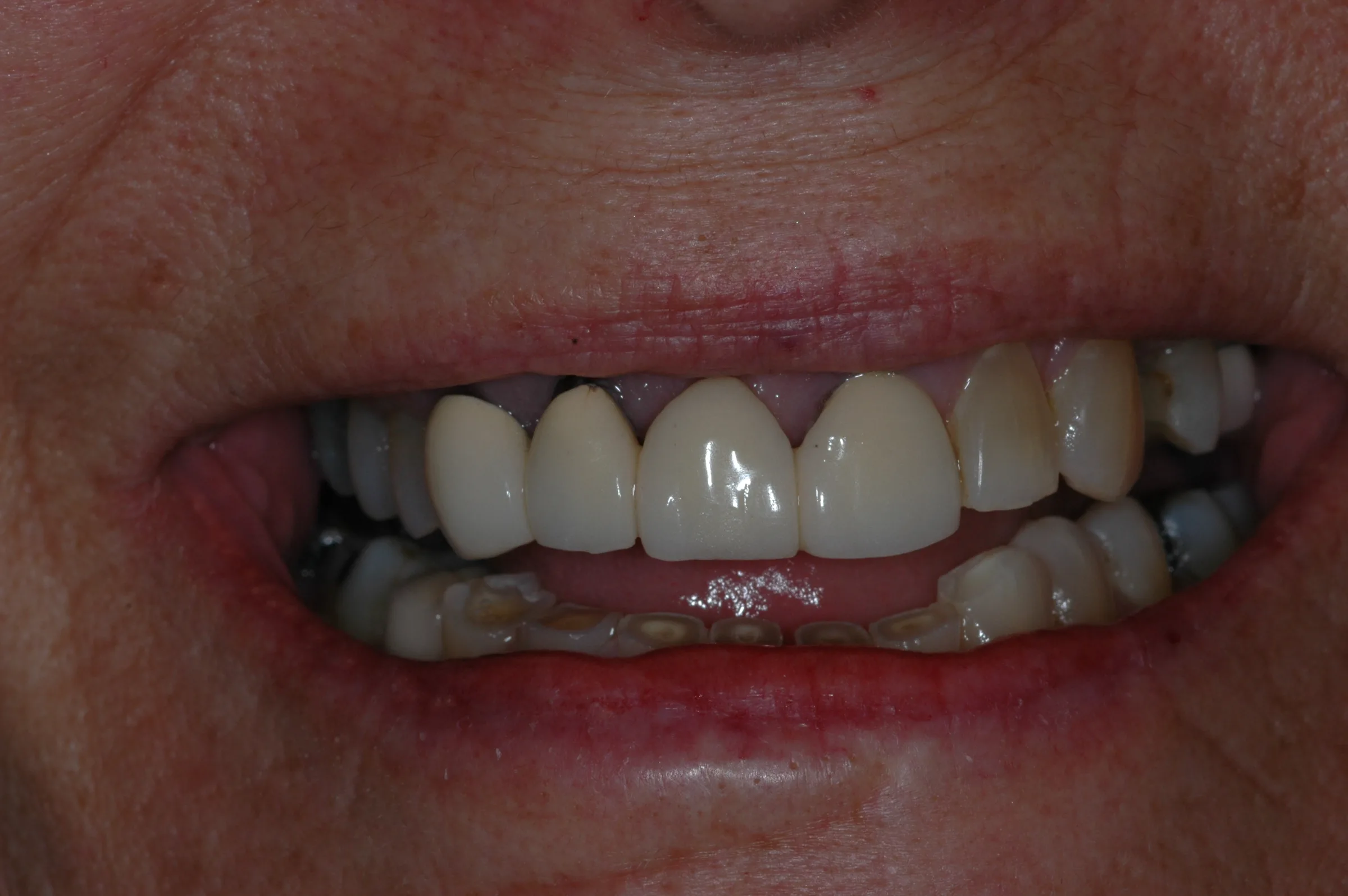 Before — Full Mouth Reconstruction