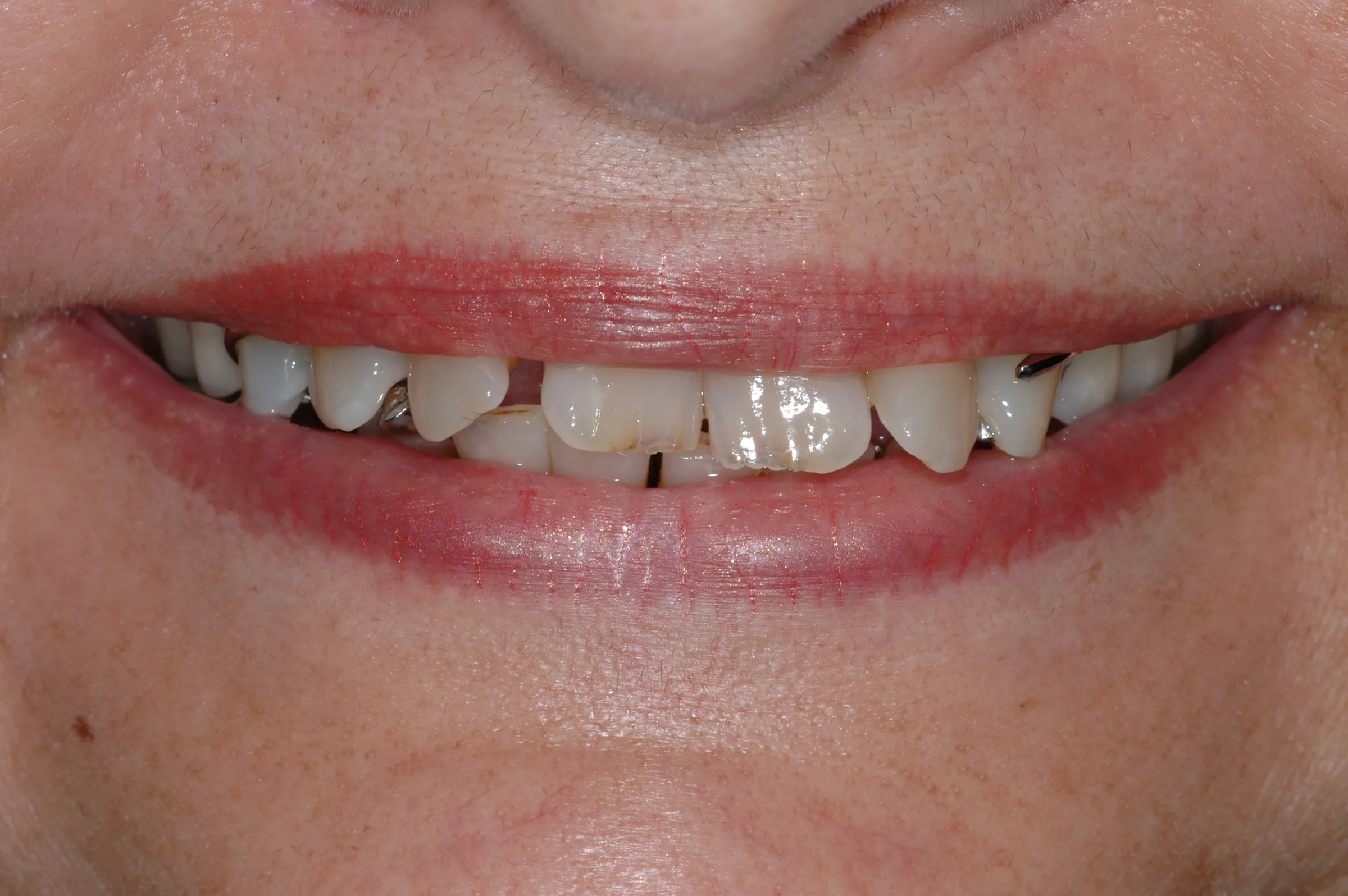 Before — Snap-On Denture