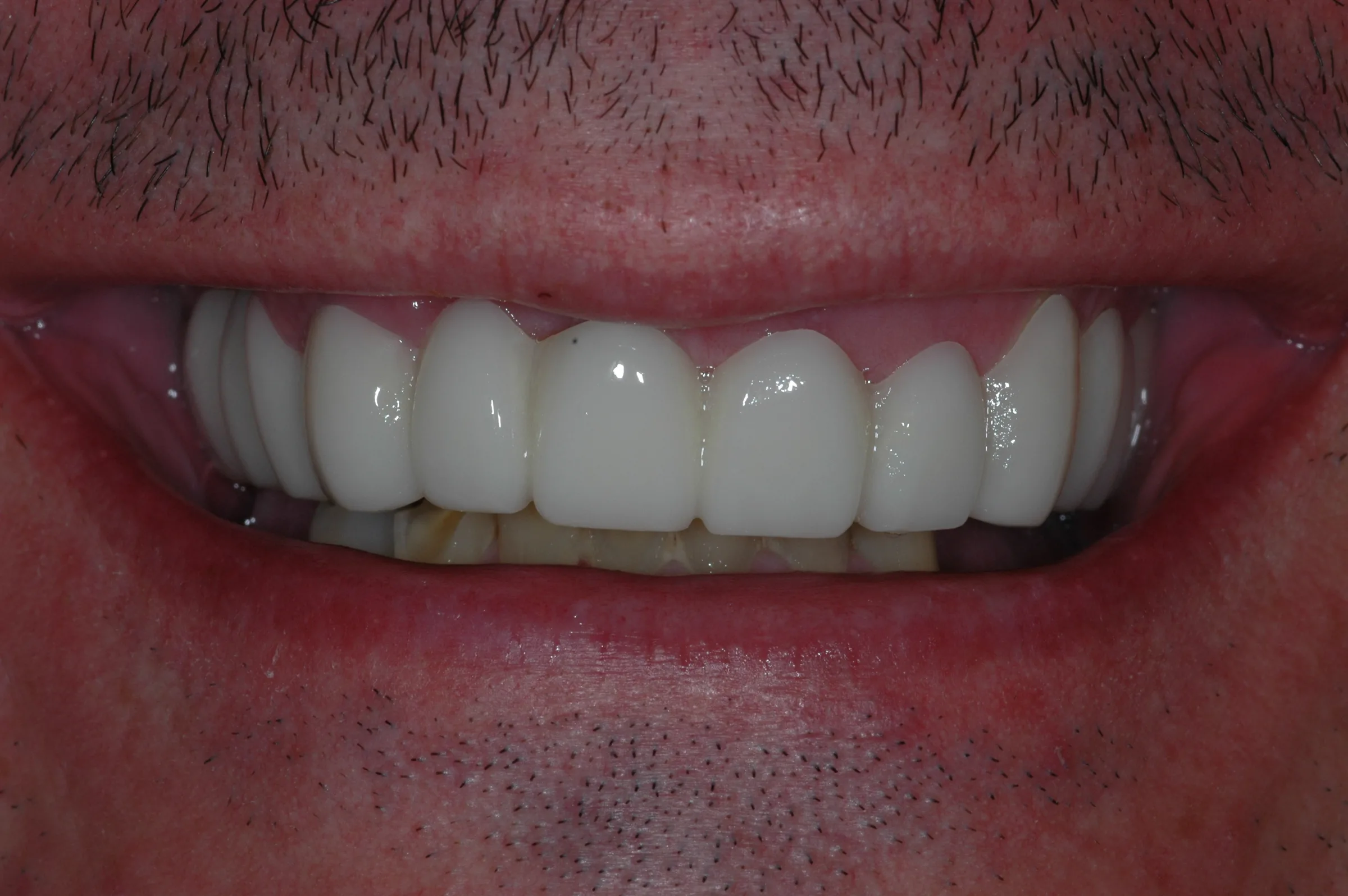 After — Other