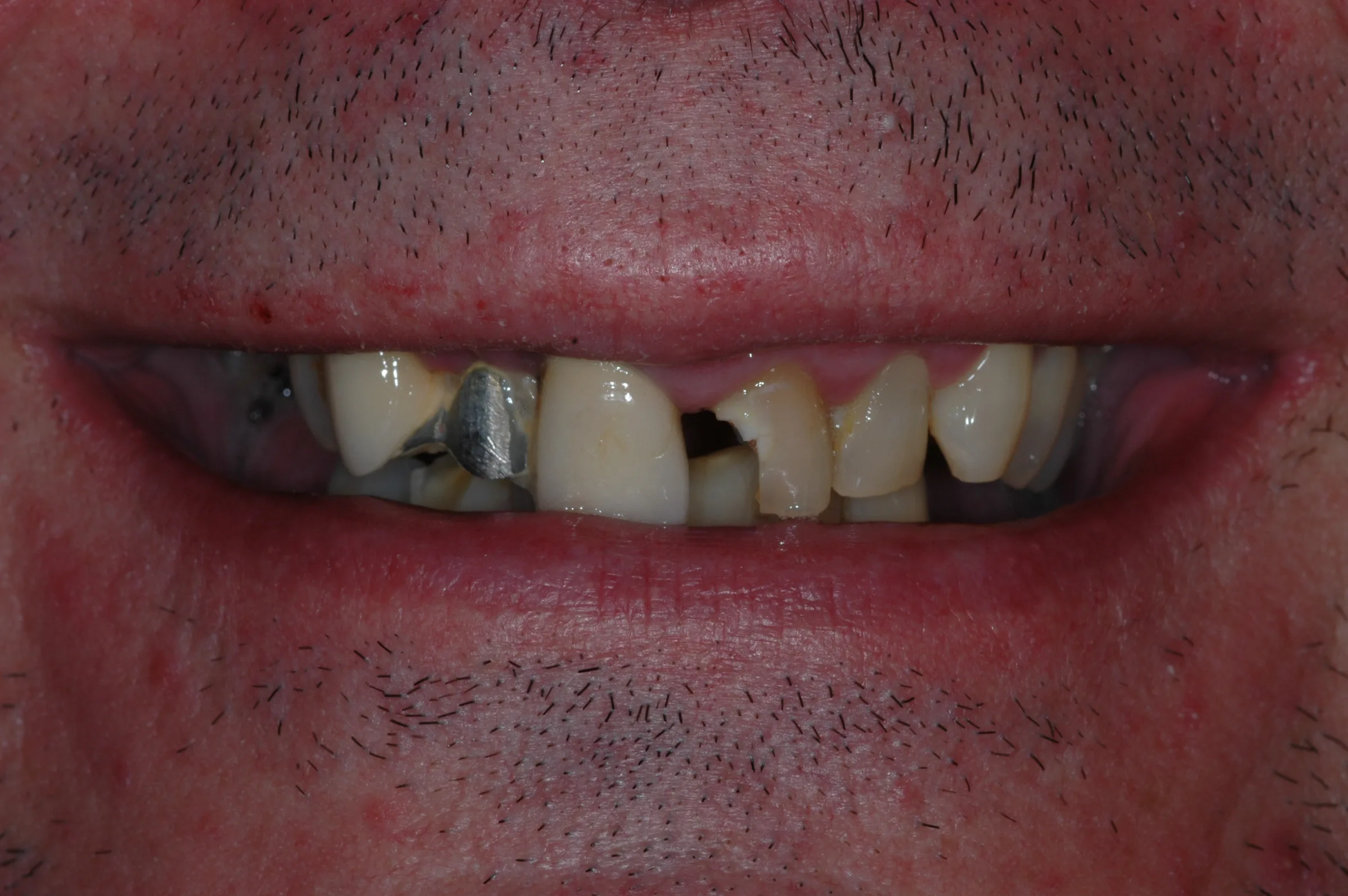 Before — Other