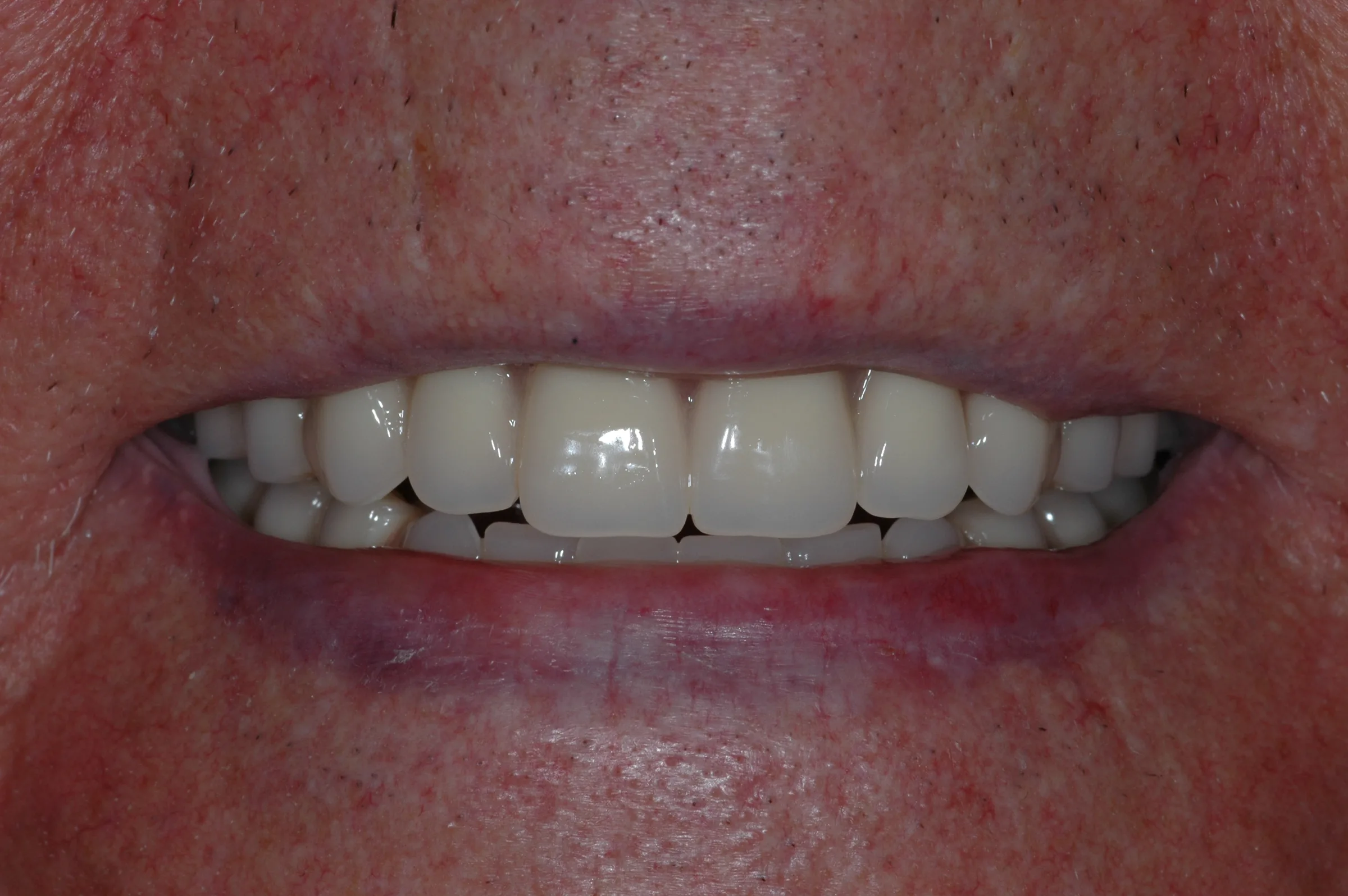 After — Dentures