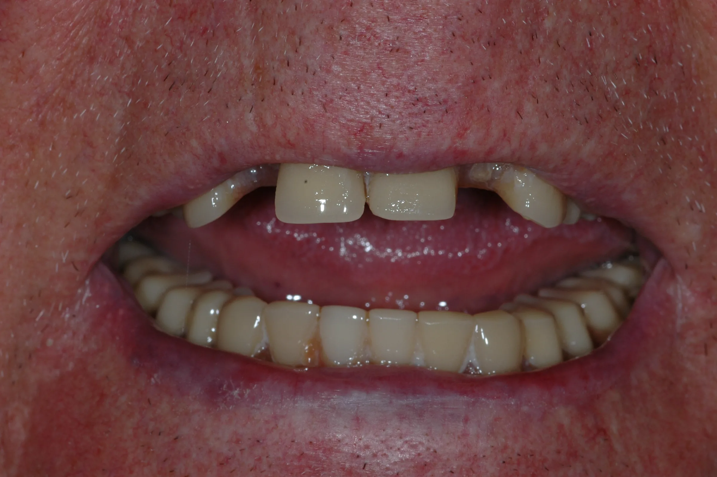 Before — Dentures