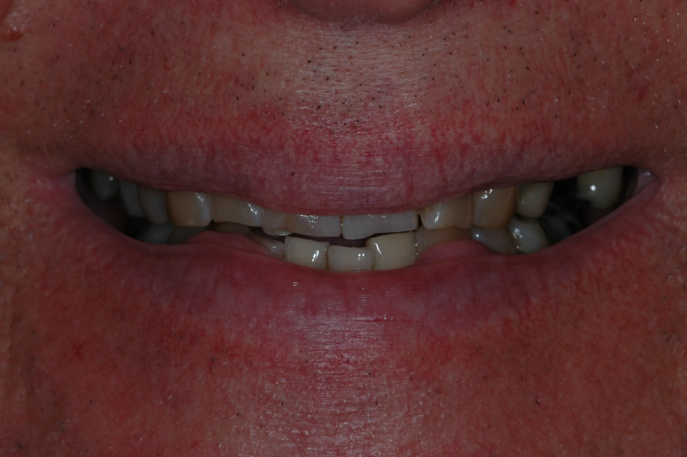 Before — Full Mouth Reconstruction