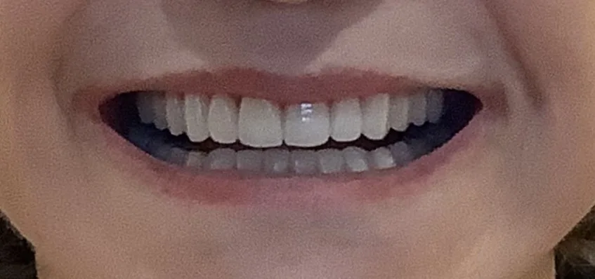 After — Full Mouth Reconstruction