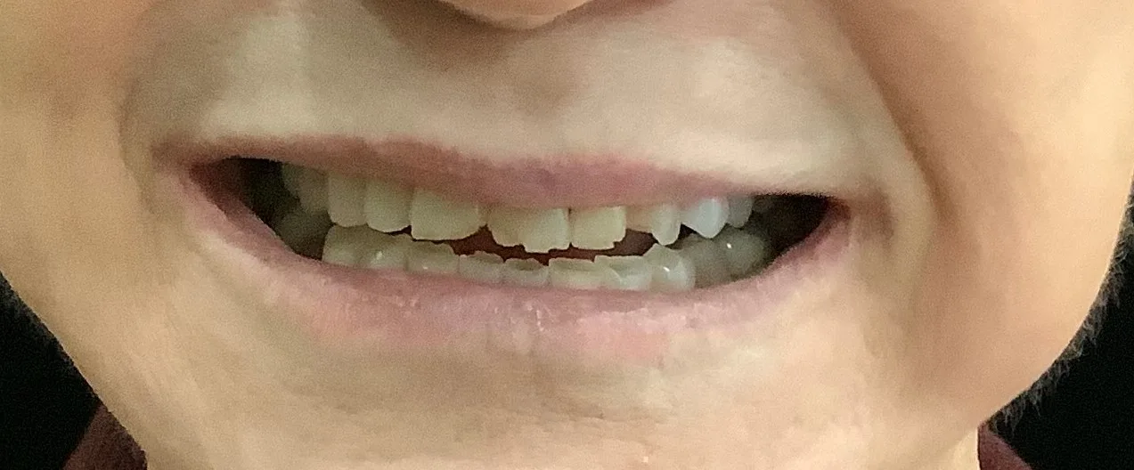 Before — Full Mouth Reconstruction