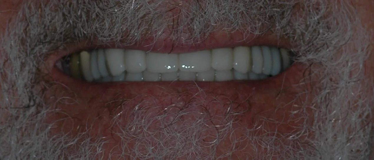 After — missing and severely worn teeth restored with zirconia crowns