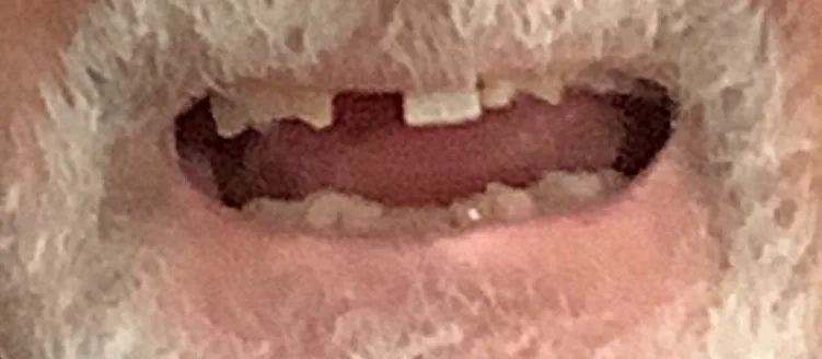 Before — missing and severely worn teeth restored with zirconia crowns