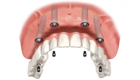 Fixed Implant Teeth