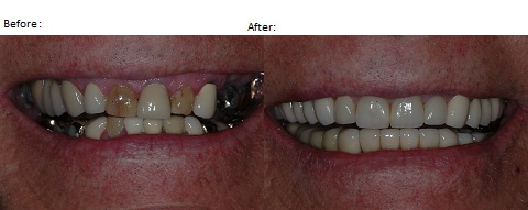 Dental Reconstruction